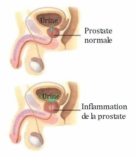 Inflammation de la prostate